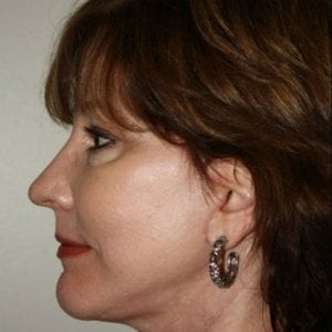 Female Facelift Patient 01 - After - 3 Thumbnail