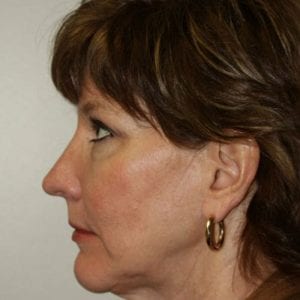 Female Facelift Patient 01 - Before - 3 Thumbnail