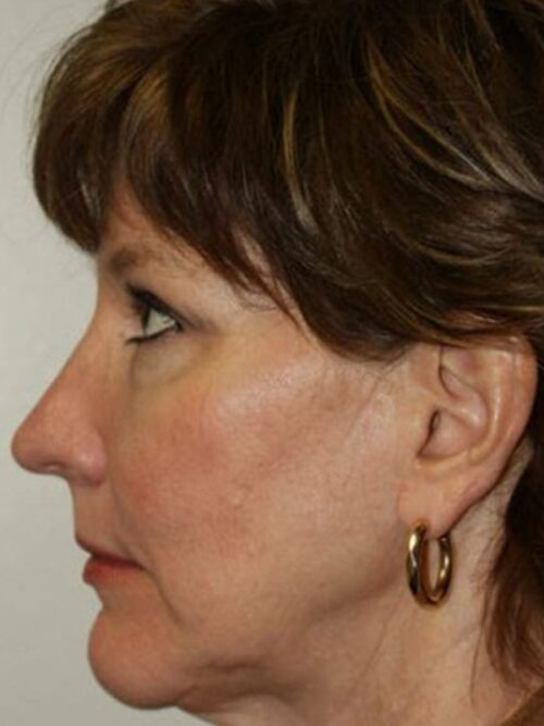 Female Facelift Patient 01 - Before - 3