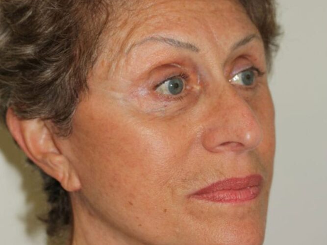 Eyelid Patient 22-2 - After - 2