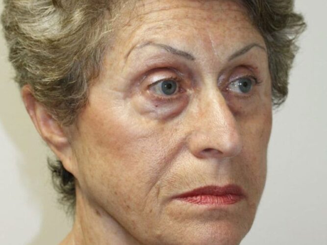 Eyelid Patient 22-2 - Before - 2