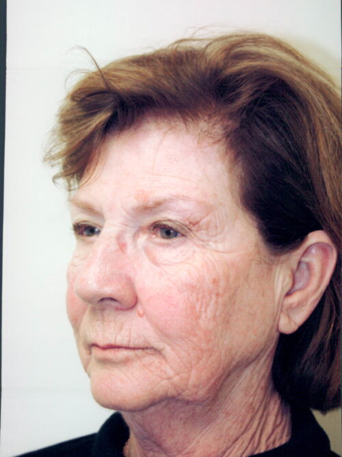 Female Facelift Patient 40 - Before - 1