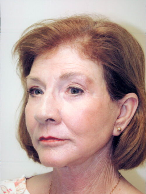 Female Facelift Patient 40 - After - 1