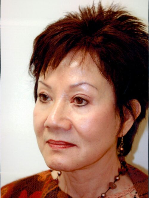 Female Facelift Patient 38 - Before - 1