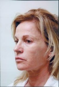 Female Facelift Patient 37 - Before - 2 Thumbnail