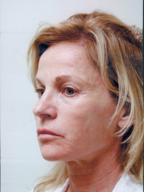 Female Facelift Patient 37 - Before - 2