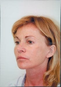 Female Facelift Patient 37 - After - 2 Thumbnail