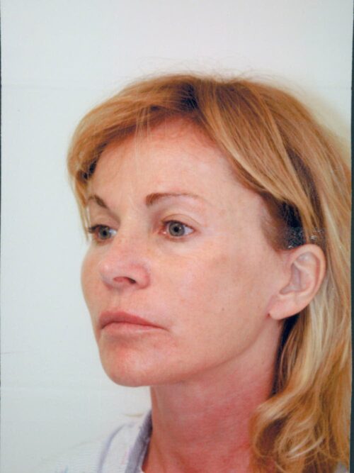 Female Facelift Patient 37 - After - 2