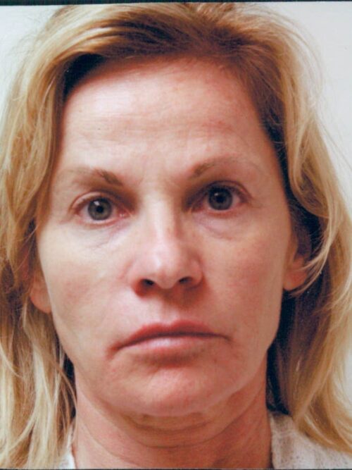 Female Facelift Patient 37 - Before - 1