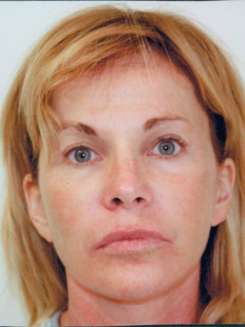 Female Facelift Patient 37 - After - 1