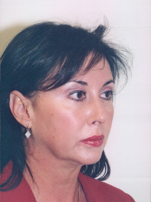 Female Facelift Patient 36 - Before - 1