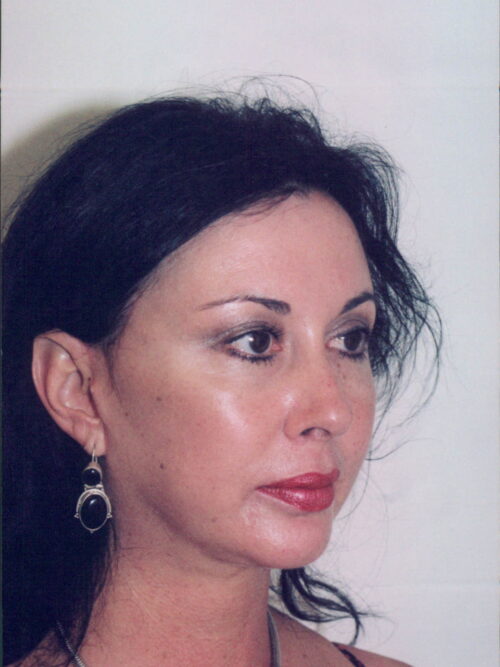 Female Facelift Patient 36 - After - 1