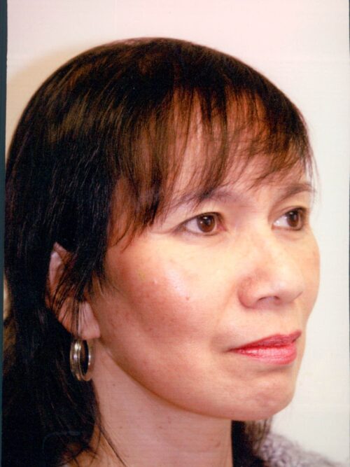 Female Facelift Patient 35 - After - 1