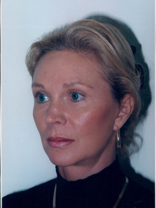 Female Facelift Patient 34 - After - 1