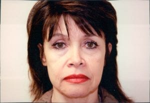 Female Facelift Patient 29 - Before - 2 Thumbnail