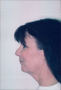 Female Facelift Patient 26 - Before - 1 Thumbnail