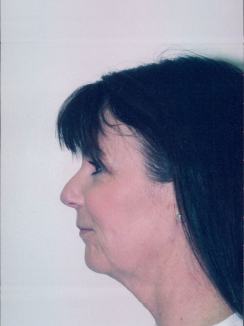 Female Facelift Patient 26 - Before - 1