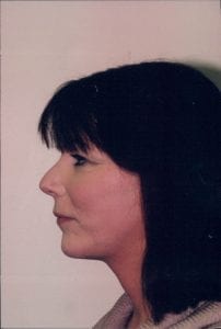 Female Facelift Patient 26 - After - 1 Thumbnail