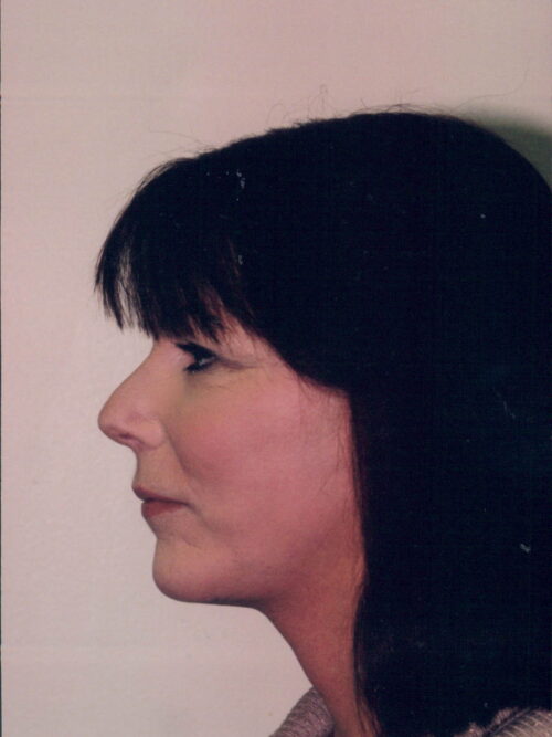 Female Facelift Patient 26 - After - 1