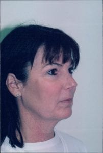 Female Facelift Patient 26 - Before - 4 Thumbnail