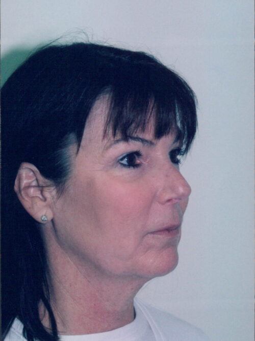 Female Facelift Patient 26 - Before - 4