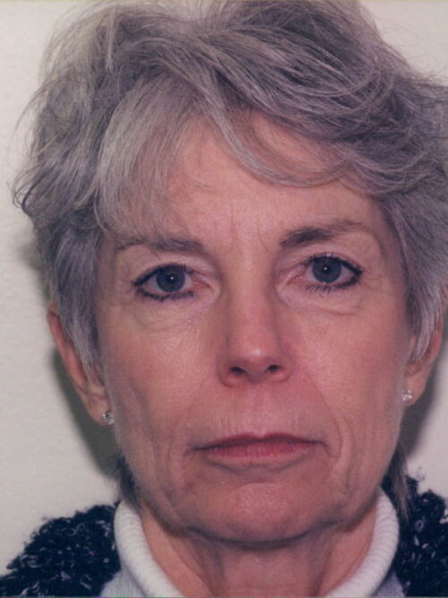 Female Facelift Patient 15 - Before - 1