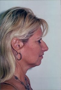 Female Facelift Patient 18 - Before - 2 Thumbnail