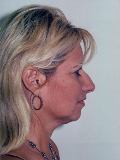 Female Facelift Patient 18 - Before - 2