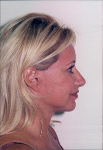 Female Facelift Patient 18 - After - 2 Thumbnail