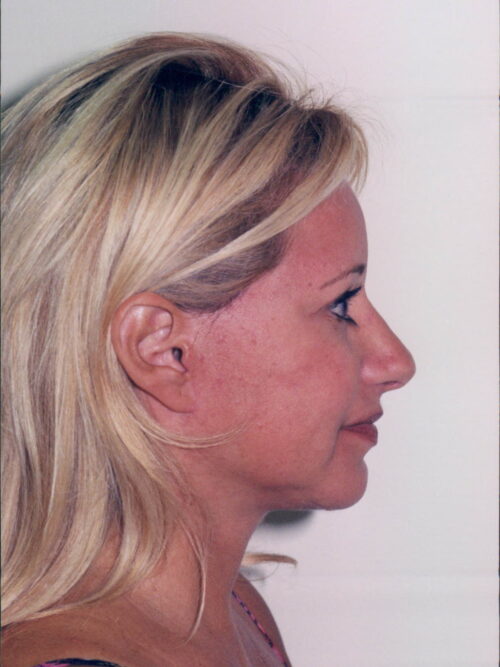 Female Facelift Patient 18 - After - 2