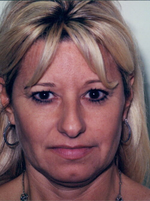 Female Facelift Patient 18 - Before - 1