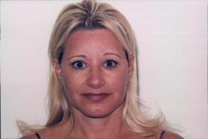 Female Facelift Patient 18 - After - 1 Thumbnail