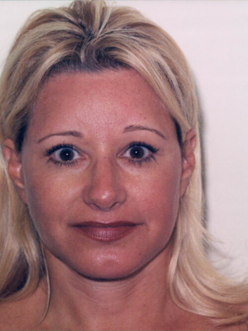 Female Facelift Patient 18 - After - 1