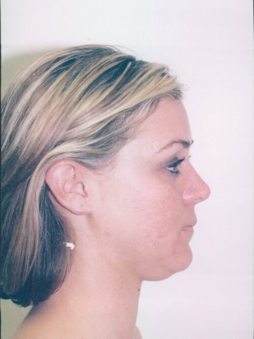 Liposuction Patient 23 - Before - 1