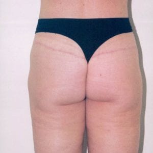 Liposuction Patient 01 - After - 1 Thumbnail