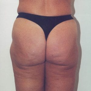 Liposuction Patient 01 - Before - 1 Thumbnail