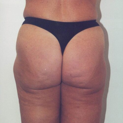 Liposuction Patient 01 - Before - 1