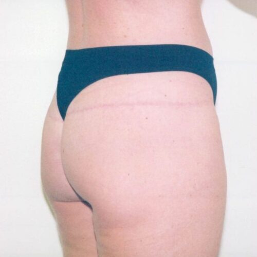 Liposuction Patient 01 - After - 2