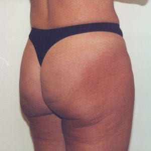 Liposuction Patient 01 - Before - 2 Thumbnail