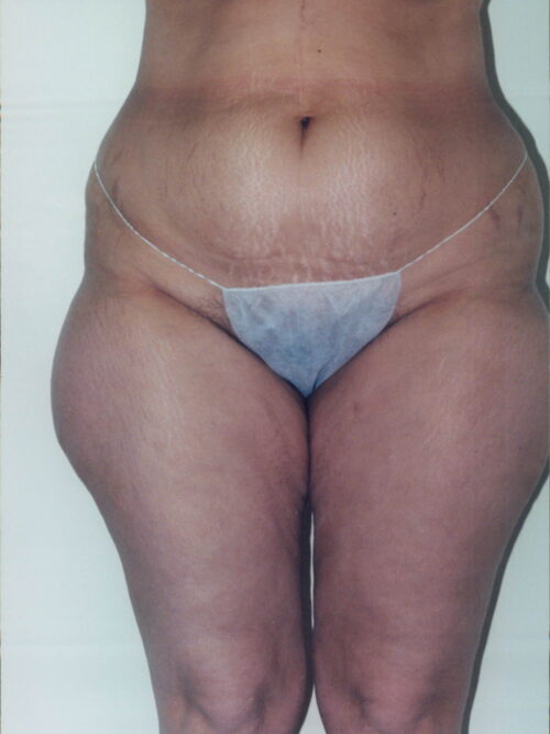 Liposuction Patient 22 - Before - 1