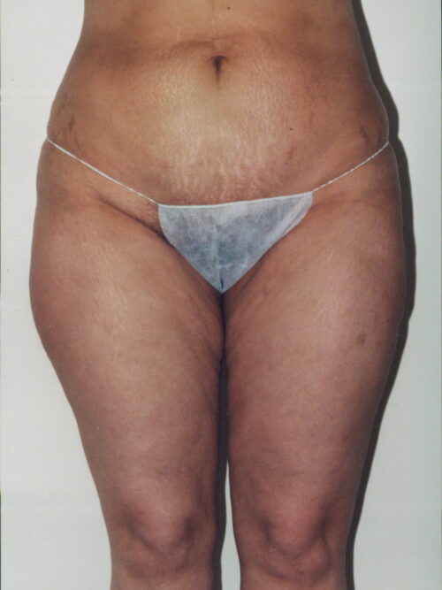 Liposuction Patient 22 - After - 1