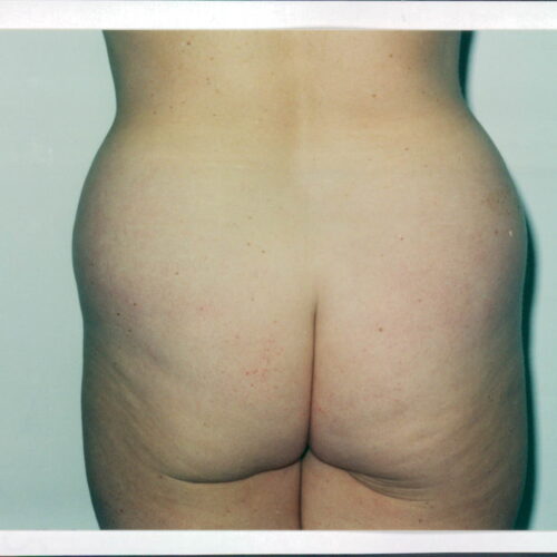 Liposuction Patient 21 - Before - 1