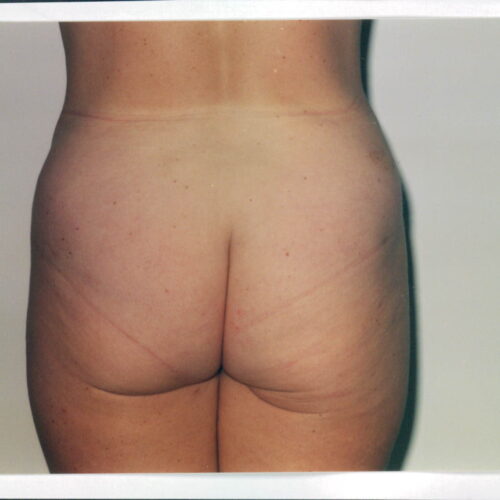 Liposuction Patient 21 - After - 1
