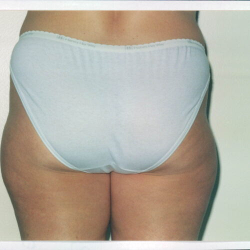 Liposuction Patient 20 - Before - 1