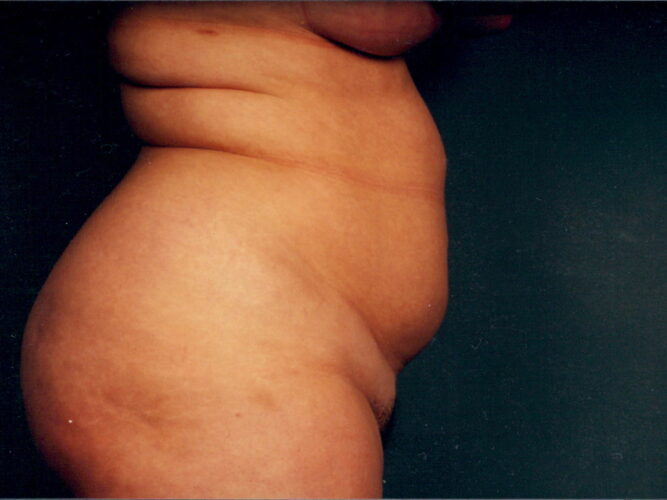 Liposuction Patient 18 - Before - 1