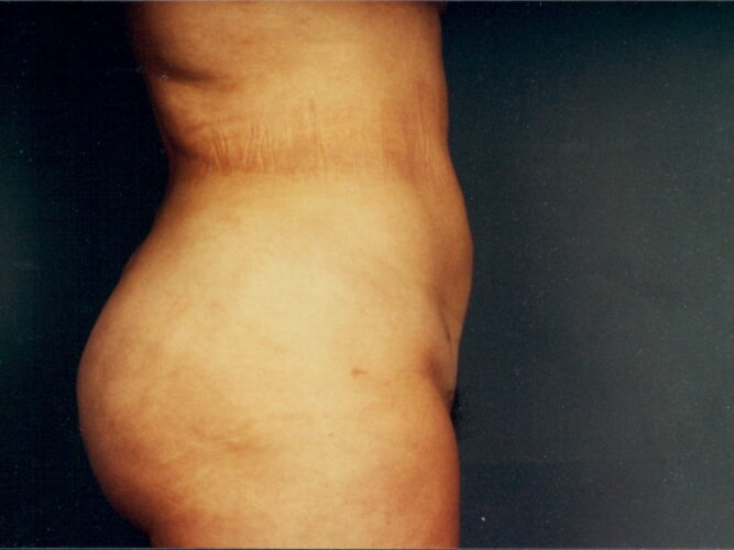 Liposuction Patient 18 - After - 1