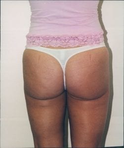 Liposuction Patient 17 - After - 2 Thumbnail