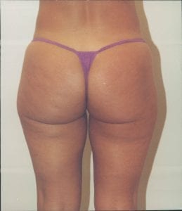 Liposuction Patient 17 - Before - 2 Thumbnail