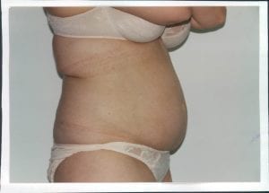 Liposuction Patient 16 - Before - 1 Thumbnail