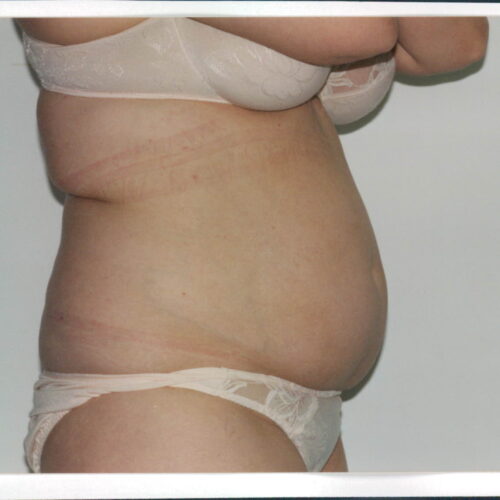 Liposuction Patient 16 - Before - 1